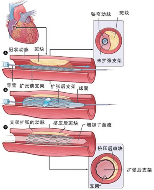 怎樣治療冠心病？(圖2)