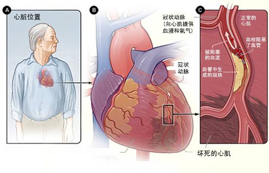 怎樣治療冠心??？(圖3)